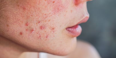 What Is Isotretinoin? Accutane Side Effects & Treatment Guide